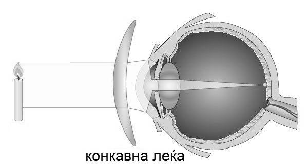 4 Оптички недостатоци на окото Окото е сложен оптички систем и често може да постоjат одредени недостатоци (мани), кое се карактеристични за оптичките