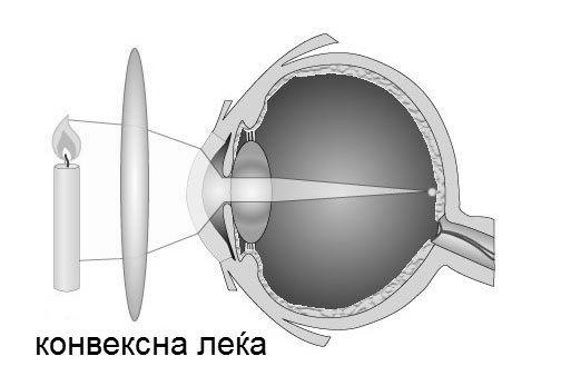 Кратковидоста наjчесто се поjавува заради развлечено очно jаболко, а недостатокот се коригира со конкавни растурни леќи, односно очила, види Слика 0.