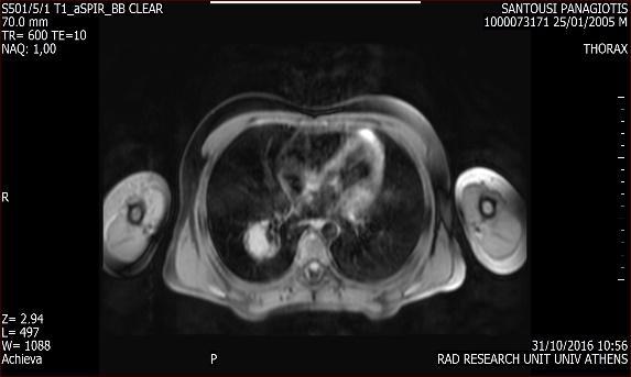 MRI κϊρακοσ Κοιλότθτα με περιεχόμενο αιμορραγικό ι πλοφςιο ςε πρωτεΐνθ