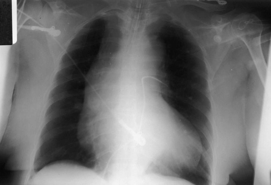 Chest x-ray