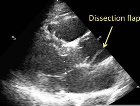 Echo TTE-TOE Intimal flap (TTE-TOE) Extent of dissection (TTE-limited TOE) TTE