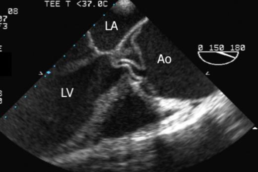 intercostal spaces, obesity, pulmonary emphysema, and mechanical ventilation