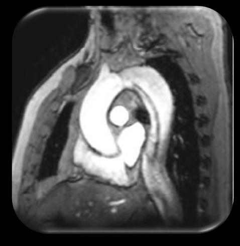 MRI Is considered the leading technique Demonstrates the extent of the disease and depicts the distal ascending aorta and the aortic arch in more detail Entry Reentry site Presence