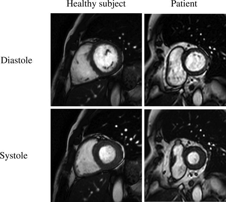 Lower LV end diastolic volume in