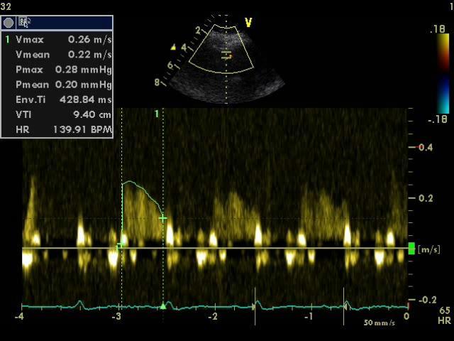 stenosis >75%