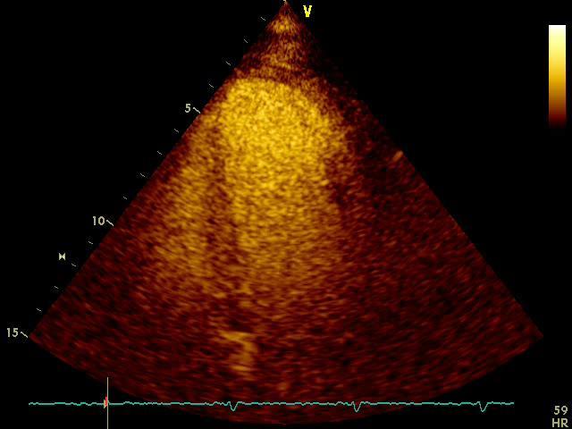 Myocardial Blood Volume β