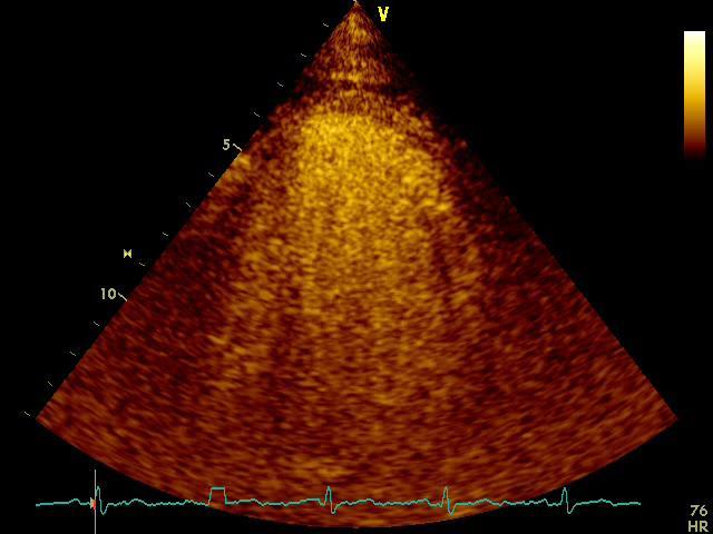 Myocardial Flow Velocity A