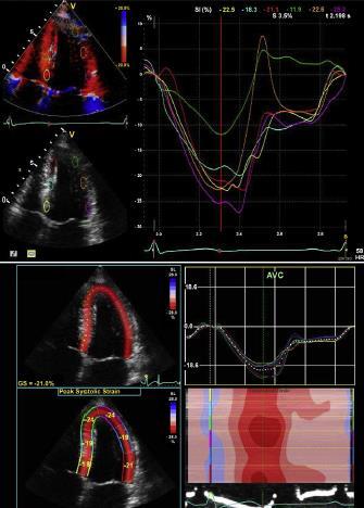 Reproducibility of Regional and Global Longitudinal Strains Derived from 2D Speckle-Tracking and DTI between Expert and Novice Readers during Quantitative DSE Interobserver variability rest low dose