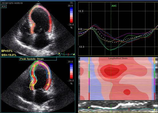 An example of a RA patient with CAD (LAD and D1) and impaired
