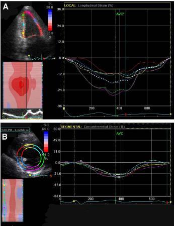 Assessment of Myocardial Viability at DSE by Deformation Analysis Using Tissue Velocity and Speckle-Tracking Longitudin al strain Circumferential strain In the presence of ischemia, longitudinal and