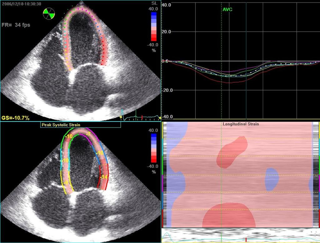 REST CONTRACTILE RESERVE