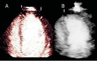 sensitivity and specificity of 2D to detect CAD were 80 and 82% and of RT3D