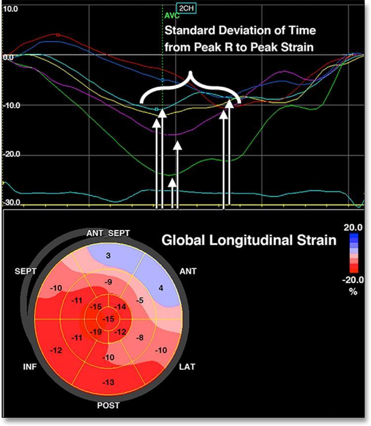GLS> - 12% MMD >61,5ms GLS< -15.