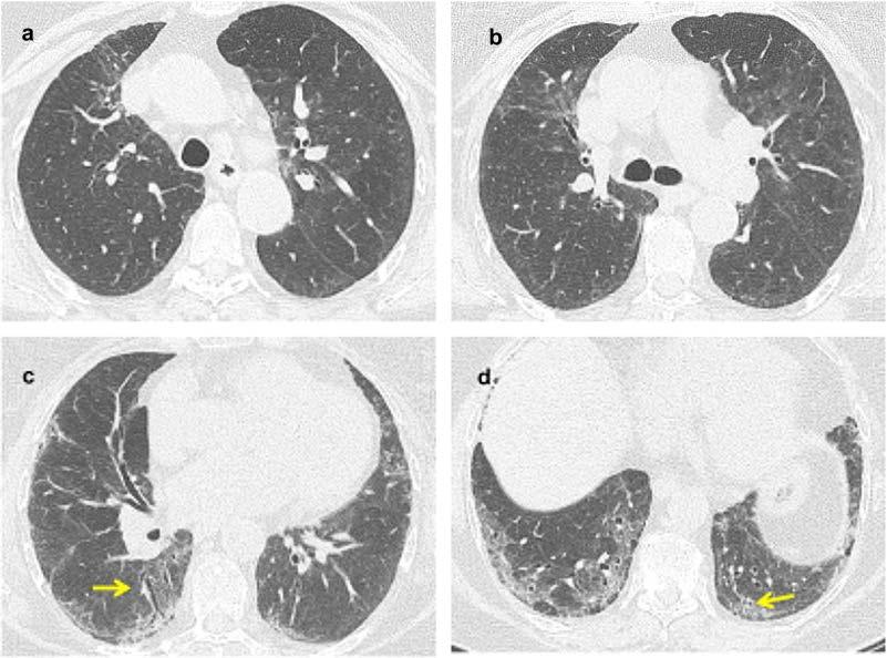 Possible (undetermined) UIP Pattern traction bronchiectasis