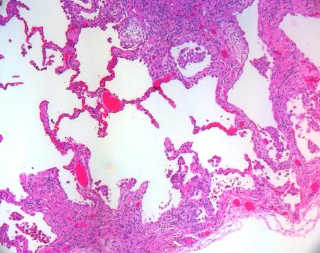 Current Definition of IPF Distinct chronic progressive fibrosing