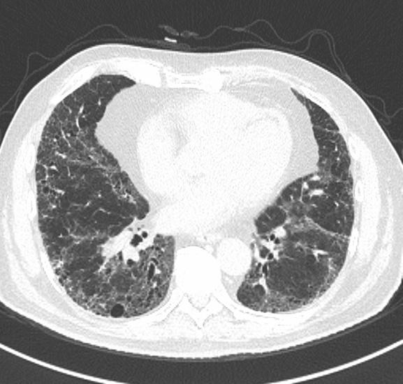 adults, is limited to the lungs, and has typical imaging and pathologic