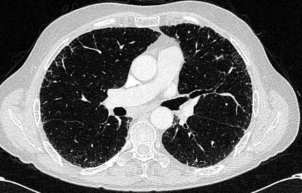 HRCT PFTs 100 Value FVC 88% predicted FEV1/FVC 89% TLC 84%