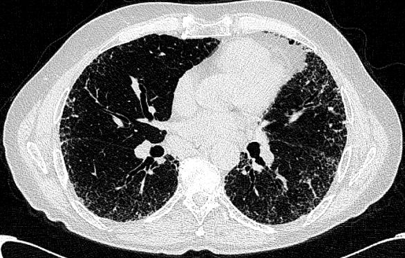 HRCT PFTs 100 Value FVC 74% predicted FEV1/FVC 88% TLC 68% predicted