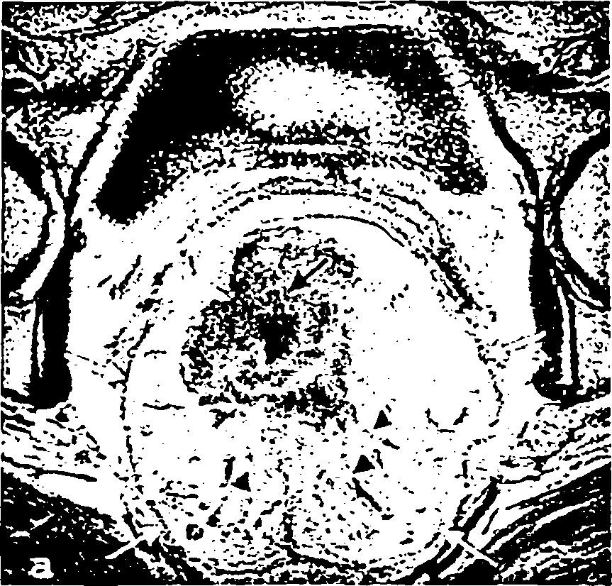 29 Εικόνα 4.3. MRI πυέλου. Διακρίνεται το ορθό που διηθείται από όγκο (μαύρο βέλος), το λίπος του μεσοορθού και η πυελική περιτονία (λευκά βέλη), που αποτελεί το όριο εκτομής ι And: Beets-Tan R.G.