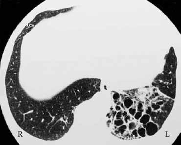 Εικόνα 10. Αερώδεις κύστεις απεικόνιση μελικηρύθρας σε διάμεση πνευμονοπάθεια Εικόνα 11. Πνευμονικό οίδημα.