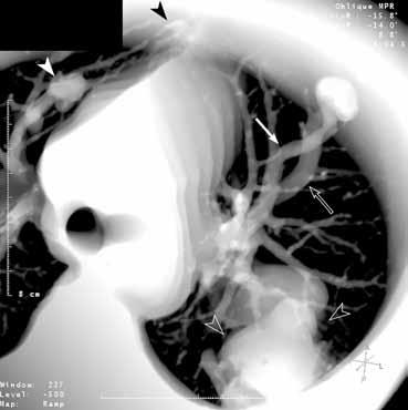 Σε ανασύνθεση από τις τομές υπολογιστικής τομογραφίας φαίνεται η ευμεγέθης αρτηριοφλεβώδης επικοινωνία (κεφαλές βελών με περίγραμμα) στο κορυφαιοπίσθιο πνευμονικό τμήμα