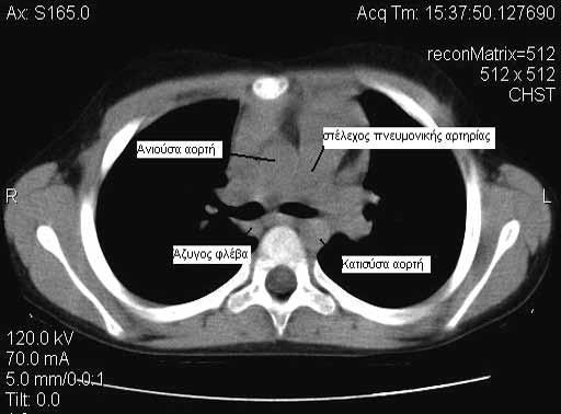 Caffey s Pediatric X-ray Diagnosis, 10th ed. St Louis: Mosby; 2004. p. 817 854. 4. Fraser RS, Müller NL, Colman N. The respiratory muscle and chest wall. In: Fraser RS and Parés PD, eds.