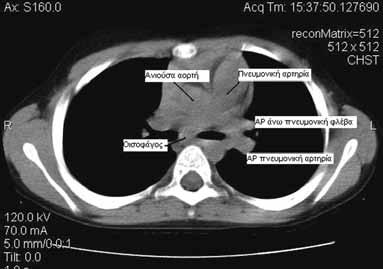 Diaphragm. In: Kuhn JP, Slovis TL, Haller JO, eds. Caffey s Pediatric X-ray Diagnosis, 10th ed. St Louis: Mosby; 2004. p. 857 866. 7. Brengle M, Cohen MD, Katz B.