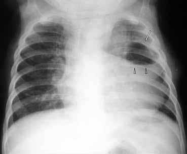 αγγείων σε συνδυασμό με αύξηση πνευμονικού όγκου στην εισπνοή που παραμένει ή επιδεινώνεται στην εκπνοή, απαντάται σε καταστάσεις παγίδευσης αέρα.