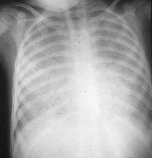 Εικόνα 11. Ευκαιριακή λοίμωξη από πνευμονοκύστη carinii. Συρρέουσες κυψελιδικές σκιάσεις με αεροβρογχόγραμμα.