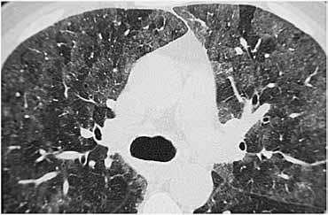 Εικόνα.10. Εστιασμένη εικόνα HRCT σε ασθενή με λοίμωξη από πνευμονοκύστη carinii. Διάχυτα διηθήματα θολής υάλου εναλασσόμενα με περιοχές φυσιολογικού πνευμονικού παρεγχύματος.