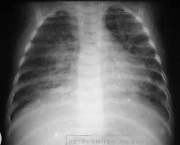 Εικόνα 4. Ιδιοπαθής αιμοσιδήρωση. Θολερότητα του κυρίως δεξιού πνεύμονα (εικόνα θολής υάλου) στην απλή ακτινογραφία θώρακος. Εικόνα 5. Χρόνια πνευμονοπάθεια αγνώστου αιτιολογίας.