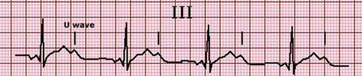 Υποκαλιαιμία ΗΚΓ αλλοιώσεις <3,5 meq/l Πτώση ST, μείωση του Τ και