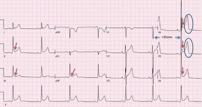 ΠΡΩΙΜΗ ΕΠΑΝΑΠΟΛΩΣΗ 29χρονος ποδοσφαιριστής με φλεβοκομβική βραδυκαρδία. Το ΗΚΓ αναδεικνύει εικόνα πρώιμης επαναπόλωσης (ανάσπαση του σημείου σύνδεσης QRS-ST (σημείο-j) 0.