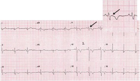 Αρρυθμιογόνος μυοκαρδιοπάθεια δεξιάς κοιλίας Το ΗΚΓ σε νέο αθλητή με αρρυθμιογόνο μυοκαρδιοπάθεια δεξιάς κοιλίας αναδεικνύει την παρουσία αρνητικών Τ