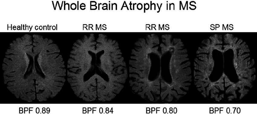 BPF brain parenchymal fraction