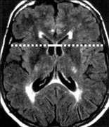 Δείκτης BCR (Bicaudate ratio) Λόγος της απόστασης των κερκοφόρων πυρήνων ICD Brain