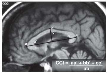 Corpus Callosum Index