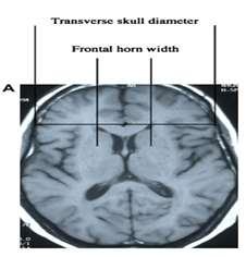 Frontal Horn Width (FHW)