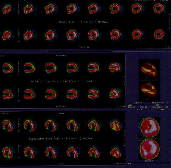 Τομογραφία μυοκαρδίου με Tc 99 Ισχαιμία στο κορυφαίο και προσθιο διαφραγματικό