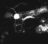 dystrophy of duodenal