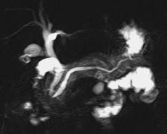 Papillary stenosis (n=5) 3.6 ± 0.7 5.5 ± 1.