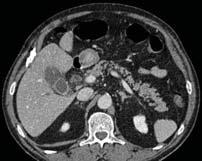 Acute Pancreatitis