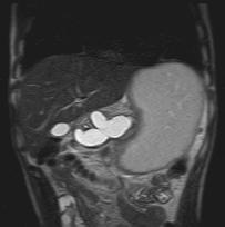 pancreatic leak with s-mrcp Gillams