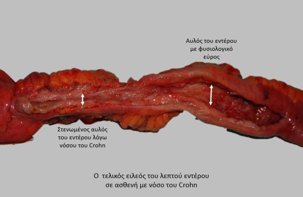 Crohn s και