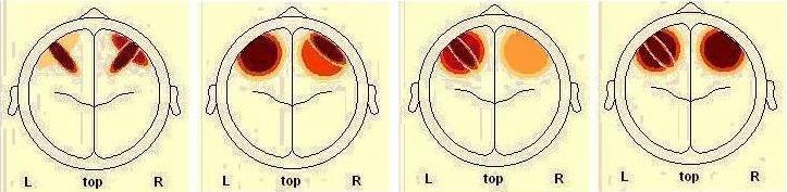 SF3 HV- άντρες HV-γυναίκες LV-άντρες LV- γυναίκες High Arousal (HA) HV- άντρες HV-γυναίκες LV-άντρες LV- γυναίκες Low Arousal (LA) Εικόνα [43] Η πηγή SF3 παρουσιάζει διαφορές ως προς την διέγερση