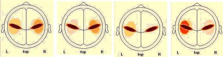 HV- άντρες HV-γυναίκες LV-άντρες LV- γυναίκες Low Arousal (LA) Εικόνα [51] Διαφορά ως προς το σθένος για την ένταση της πηγής SC3, που εμφανίζεται με μεσαία ένταση σε όλες τις καταστάσεις του υψηλού