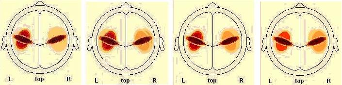 SC5 HV- άντρες HV-γυναίκες LV-άντρες LV- γυναίκες High Arousal (HA) HV- άντρες HV-γυναίκες LV-άντρες LV- γυναίκες Low Arousal (LA) Εικόνα [52] Διαφορές ως προς τη διέγερση για την πηγή SC5 όσο αφορά