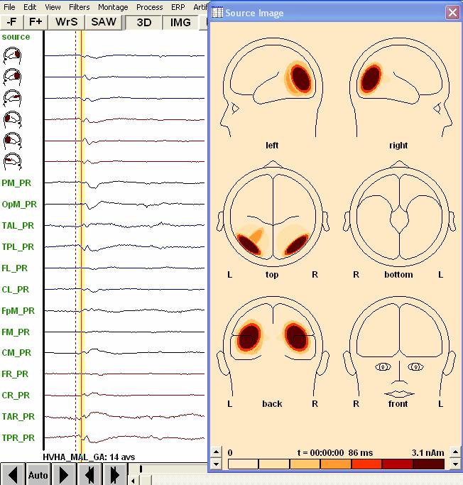 ΠΛΕΥΡΙΚΗ ΠΕΡΙΟΧΗ (PARIETAL REGION) ΚΟΡΥΦΩΣΗ P1 Εικόνα [81]