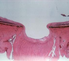 Η απϊλεια των γαγγλιακϊν κυττάρων είναι το αποτζλεςμα των ποικίλλων διεργαςιϊν που ςυμβαίνουν ςτο γλαφκωμα, που ςυνεπάγεται και τθν εκφφλιςθ των νευριτϊν τουσ, δθλαδι των νευρικϊν ινϊν.