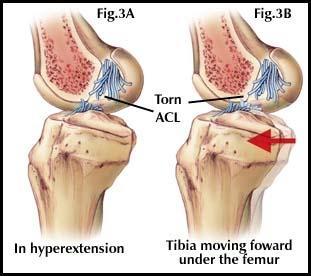 MRI σε διαφορετικές θέσεις κάµψης έκτασης, µε ή χωρίς φορτίο: ü Διαταραχές στο πρότυπο επαφής µηρού κνήµης ü πρόσθιας παρεκτόπισης της κνήµης ü Διαταραχές της έσω/έξω στροφής της κνήµης Barrance PJ,